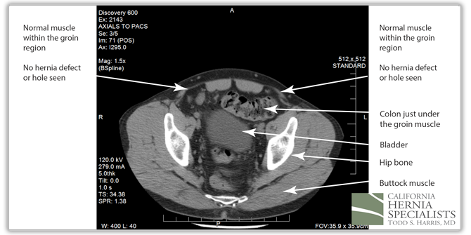 Normal muscles of the abdomen